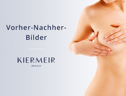 Vorher Nachher Bilder Brust-OP Kiermeir Breast in Bern 