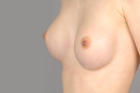 Brustvergrößerung mit Implantat nachher 
