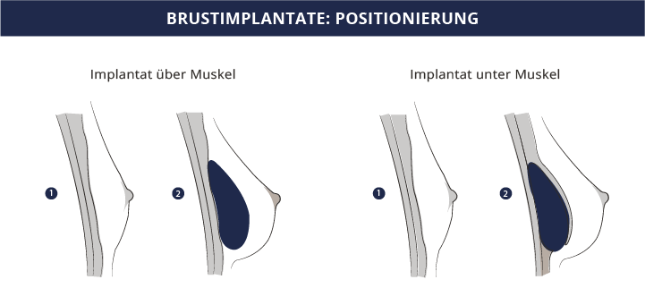 Brustimplantate Position, Dr. Kiermeir, Bern 