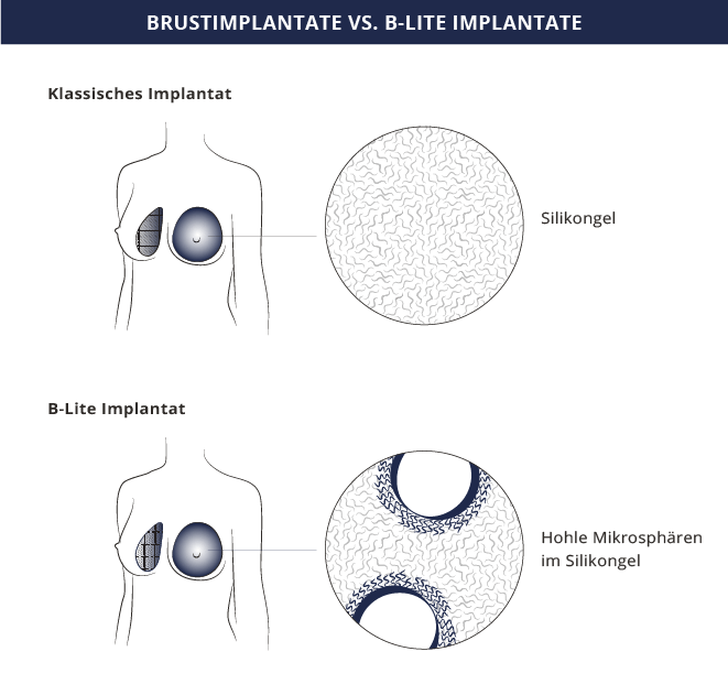 Brustimplantate vs. B-Lite, Dr. Kiermeir, Bern 