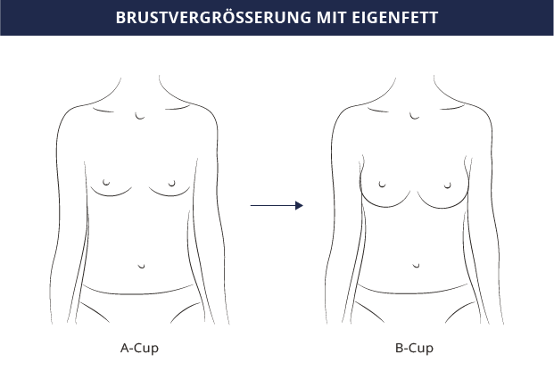 Brustvergrösserung mit Eigenfett, Dr. Kiermeir, Bern 
