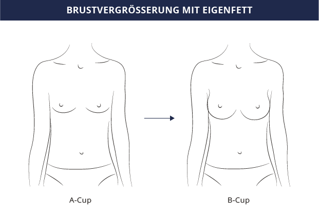 A auf b brustvergrößerung Brustvergrößerung A