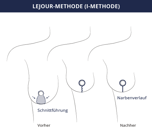 grafik_brustverkleinerung_i-schnitt_kiermeir_bern.png 