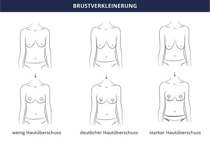 Brustverkleinerung, Dr. Kiermeir, Bern 