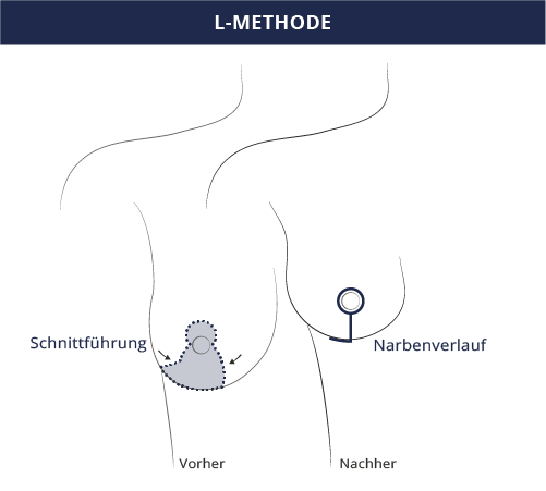 grafik_brustverkleinerung_l-methode_kiermeir_bern.png 