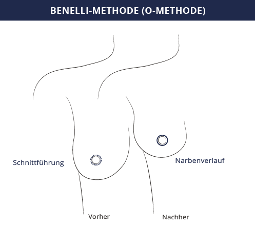 grafik_brustverkleinerung_o-schnitt_kiermeir_bern.png 