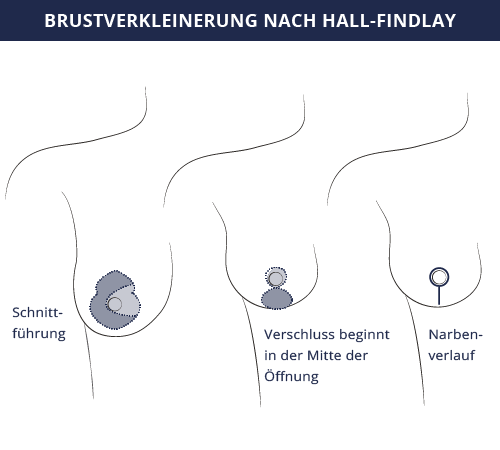 grafik_brustverkleinerung_schnittfuehrung_kiermeir_bern.png 