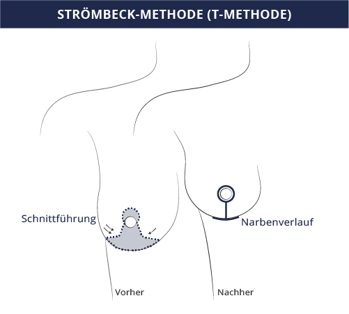 grafik_brustverkleinerung_t-schnitt_kiermeir_bern.png 