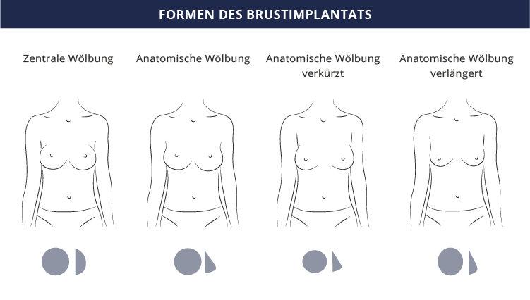 Formen Brustimplantate, Dr. Kiermeir, Bern 